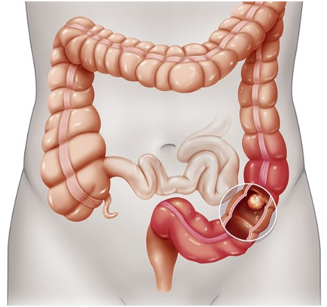 Kolorektal Kanser by Zeynep Turan - Illustrated by Zeynep - Ourboox.com